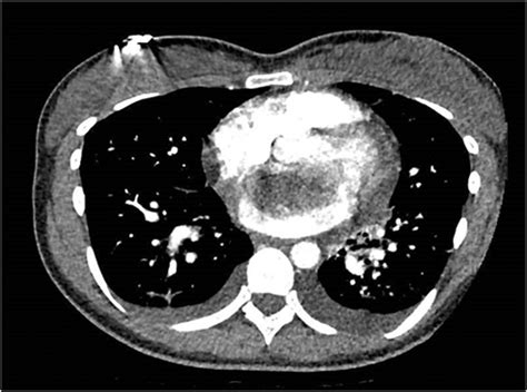 Ct Pulmonary Angiogram Ctpa Demonstrating A Left Atrial Mass