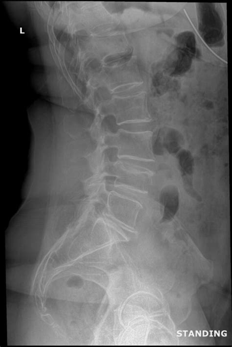 OrthoDx Acute Lumbar Compression Fracture Clinical Advisor