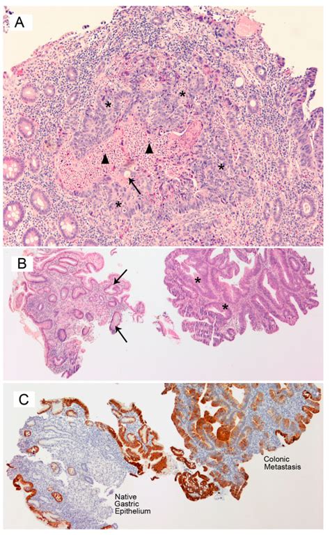 Histopathology Of The Endoscopic Colonic Biopsy Hematoxylin And Eosin Download Scientific