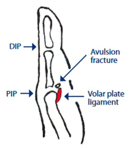 Volar Plate Ligament Injury Of The Finger Hand Therapy