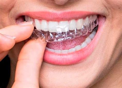 Invisalign Bogot Alineadores Clear Aligner Ortodoncia Sin Brackets