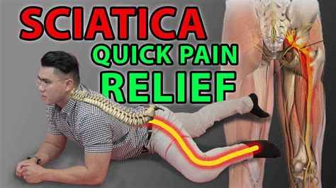 How To Alleviate Sciatica Pain - Crazyscreen21