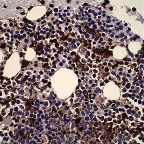 Bone Marrow Biopsy The IHC Stain Was Also Positive For KP1 CD68