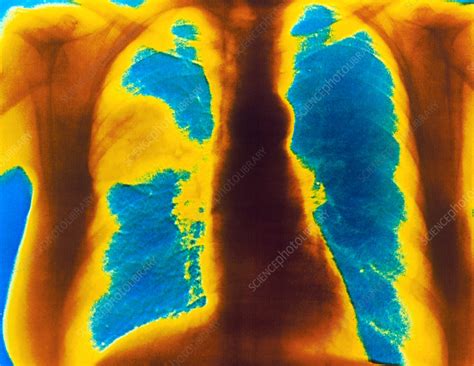 Chest X Ray Showing Lobar Pneumonia Stock Image M240 0236 Science Photo Library