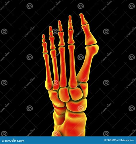 Toe Deformation, Also Known As Hallux Valgus, or Bunion Stock