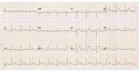 Neurogenic Shock - New