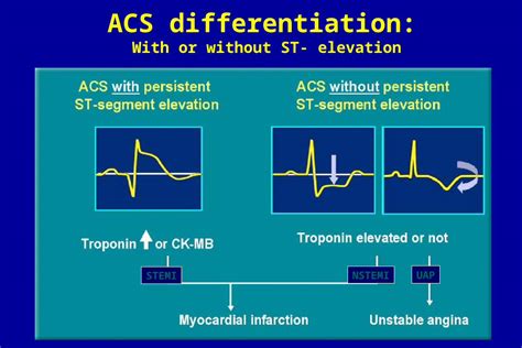 Ppt Acs Differentiation With Or Without St Elevation Stemi Nstemi