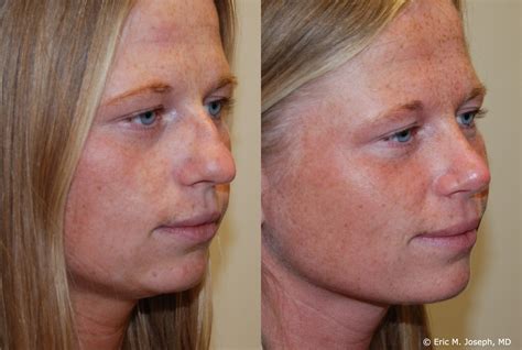 Eric M Joseph Md Rhinoplasty Before And After Deviated Septum Correction