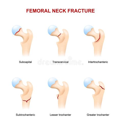 Pescoço Da Fratura Do Fêmur Ilustração Do Vetor Ilustração De Medicina Diagrama 78934145