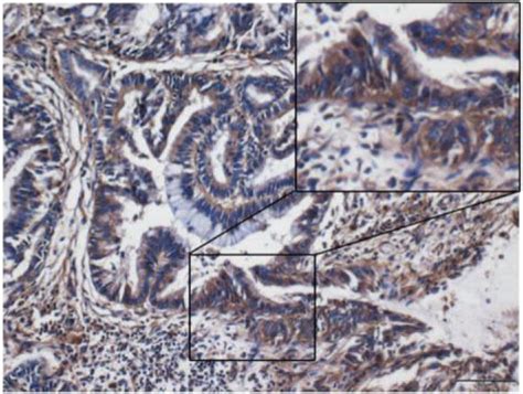 Ihc Detection Of Differential Protein Expression In Pdac Tissue