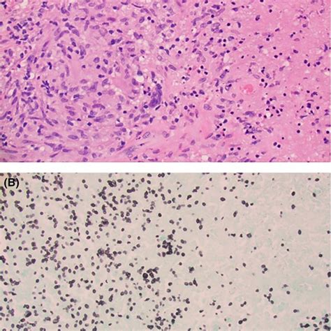 Biopsy Histology A Hematoxylin And Eosin Stain Magnification 400x