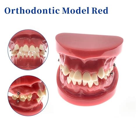 Orthodontic Tooth Model Demonstration Teaching Doctor Patient