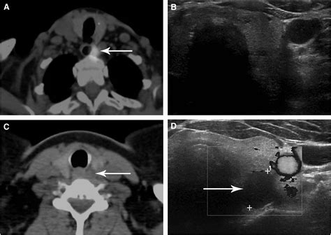 Spect Ct Guided Ultrasound For Parathyroid Adenoma Localization A 1