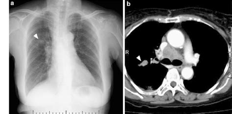 Chest X Ray And Ct Of The Patient Chest X Ray A And Ct B On The