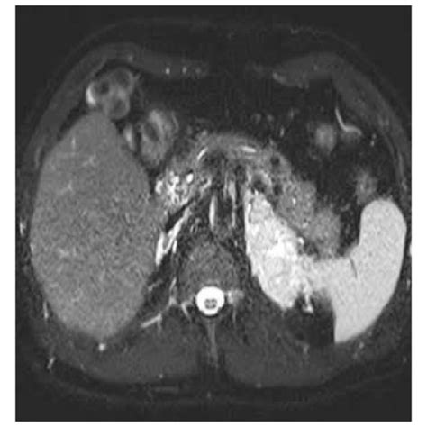 A Coronal T2 Weighted And B Axial Fat Saturated T2 Weighted Images