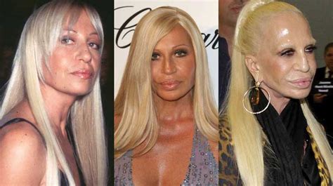 Donatella Versace Plastic Surgery Before and After Pictures 2024