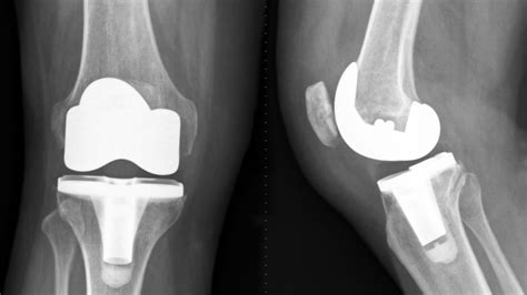 Biomet Knee Implant Recalls