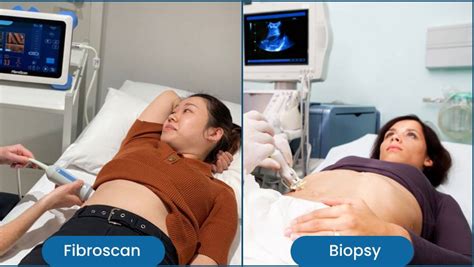 FibroScan Vs Biopsy Comparing Liver Fibrosis Assessment Techniques