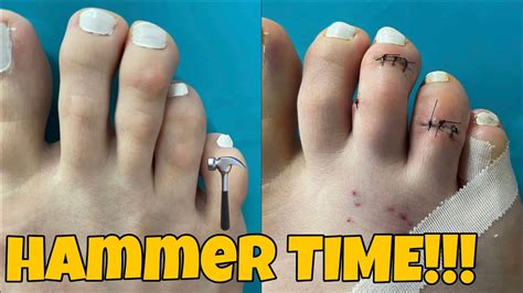 Minimally Invasive Hammertoe Surgery Youtube