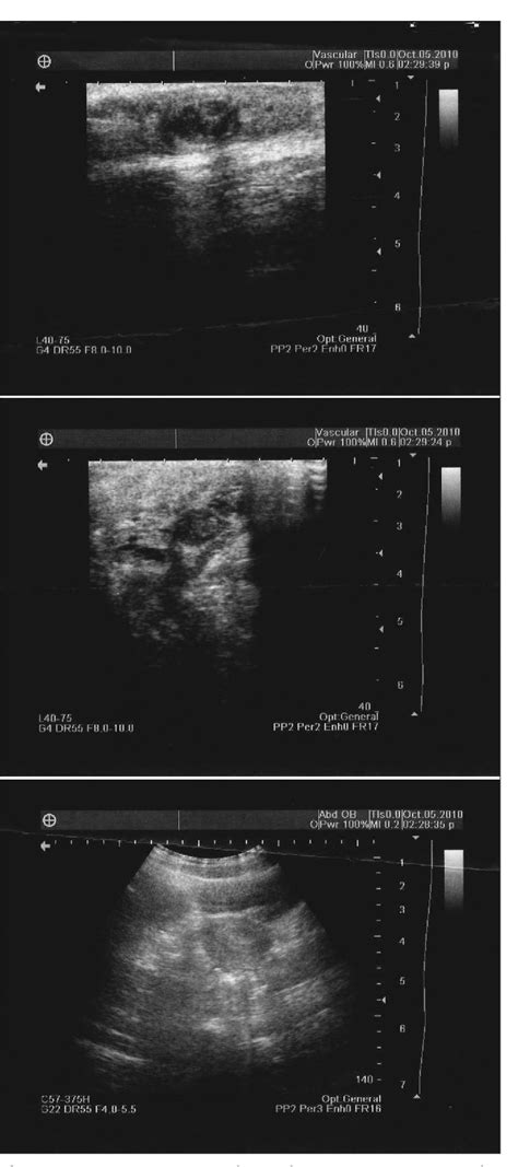 Figure 1 From Clitoromegaly Caused By Cavernous Hemangioma A Rare Case