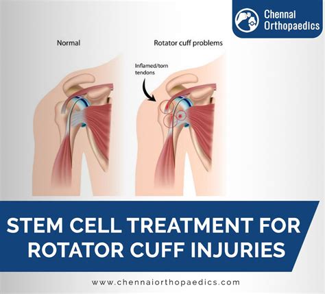 Stem Cell Therapy For Rotator Cuff Injuries Advanced Healing Options