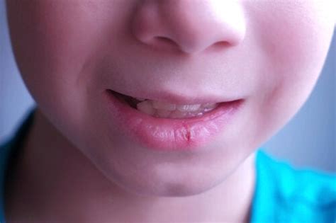 Chapped Lips In Children Causes And Recommendations