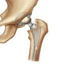 Nieuwe Heup Oefeningen En Behandeling Fysiotherapie4all