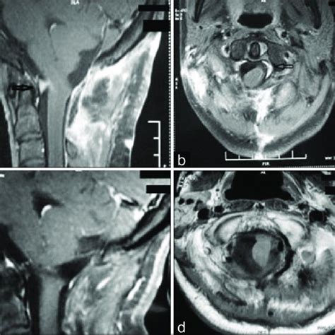 A Postoperative Sagittal Contrast Enhanced Magnetic Resonance Imaging