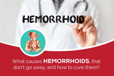 What Causes Hemorrhoids And How To Cure Them Hemorrhoids Treatment