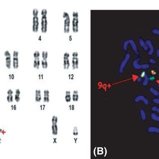 A Karyotype Analysis Indicates The Translocation T Q Q