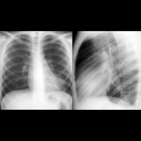 Pediatric Bronchiectasis Pediatric Radiology Reference Article Pediatric Imaging Pedsimaging