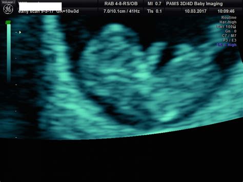 Early Pregnancy Scan | Private One-On-One Pregnancy & Fertility ...