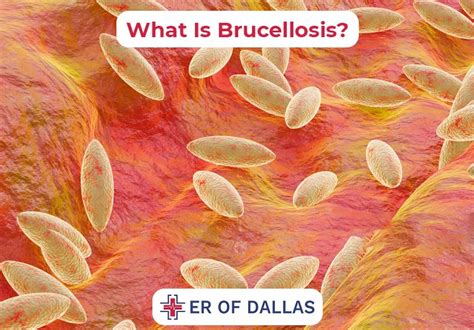 Brucellosis Causes Symptoms And Treatment Options Er Of Dallas