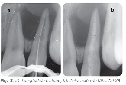 Revista Canal Abierto Endodontic Treatment Of A Tooth With Dens