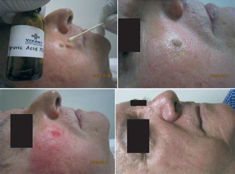 Figure 1 From Pyruvic Acid Facilitates The Removal Of Actinic Keratoses