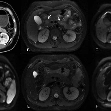 A Ct Scan Of Portal Phase Displaying Hypoattenuating Mass Lesions