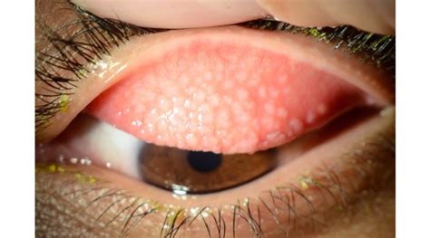 Blepharoconjunctivitis Causes Symptoms And Treatment OBN