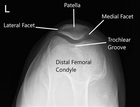 Case Study Patellofemoral Chondroplasty In Yr Old Female