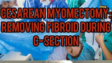 Cesarean Myomectomy Removing Fibroids During C Section Youtube