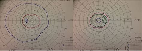 How To Interpret Visual Fields Practical Neurology