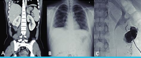 Imaging studies demonstrating a ruptured right renal abscess with... | Download Scientific Diagram