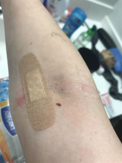 Fragile Skin Is Not A Joke This Bandage Is Covering Up The Wound