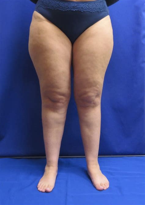 Qué es el lipedema Una guía completa sobre la enfermedad