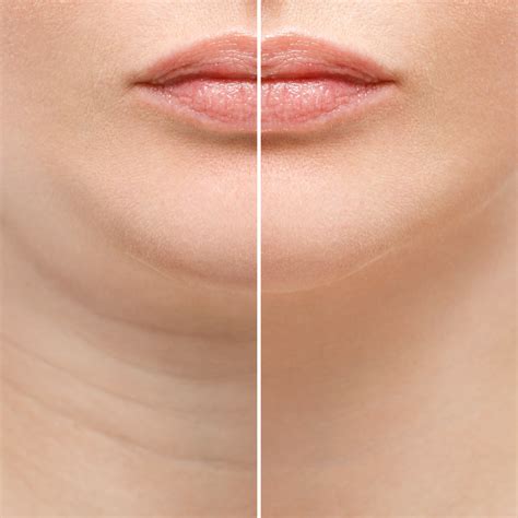 Kybella Double Chin Treatment Capizzi Md