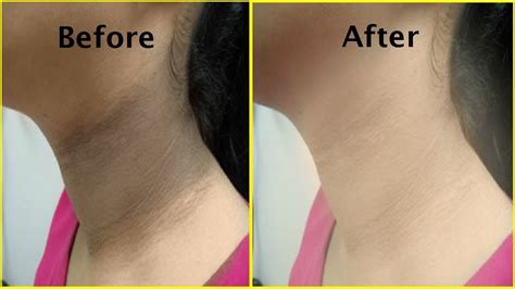 काली गर्दन को गोरा कैसे करे Acanthosis Nigricans Dark Neck Treatment Black Neck Removal