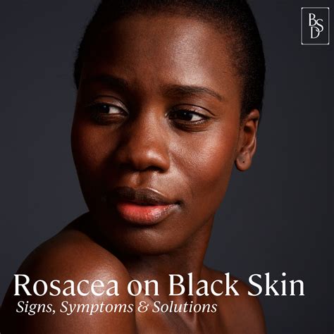 Black Skin And Rosacea — Black Skin Directory