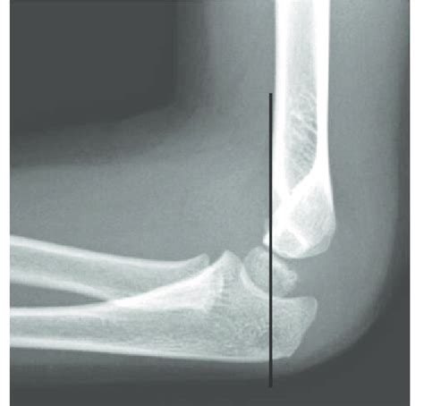 Anterior Humeral Line Radiology