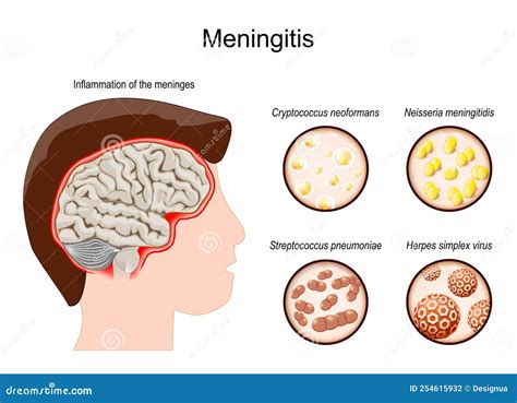 Meningitis Is An Inflammation Of The Meninges The Membranes That Surround The Brain And Spinal