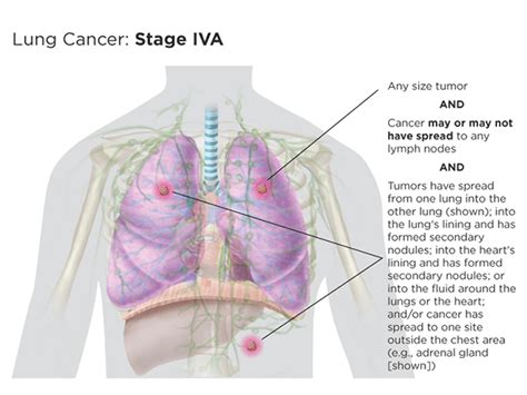 tumor size chart lung cancer