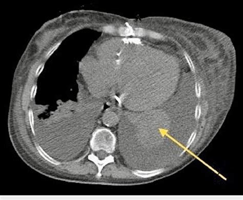 Ct Thorax Showing Sub Pleural Mass Forming An Acute Angle With The